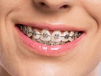Closeup smile with bracket and wire braces