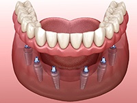 Illustration of implant dentures in Midlothian, TX 