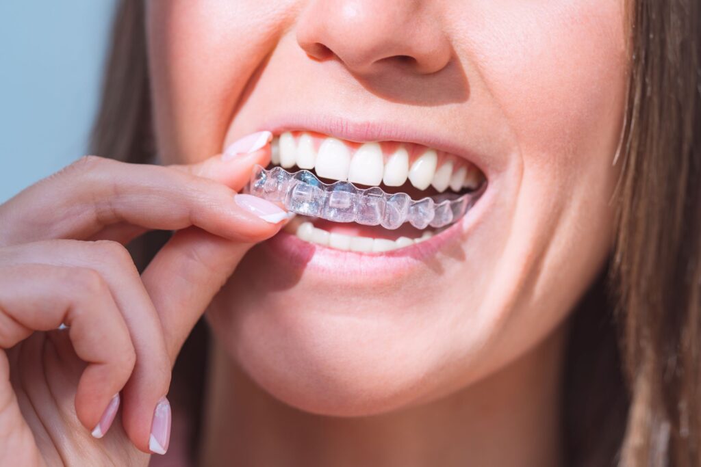 Nose-to-neck view of woman inserting Invisalign over top teeth